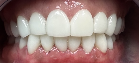 Full mouth reconstruction after