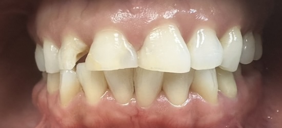 Full mouth reconstruction before