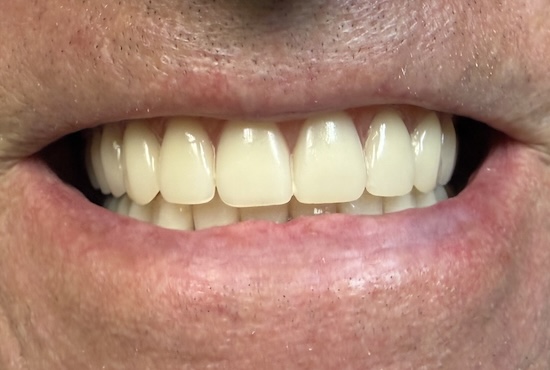 Complete dentures after