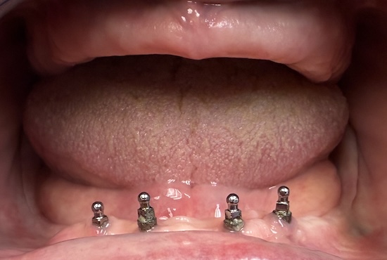 Complete dentures before
