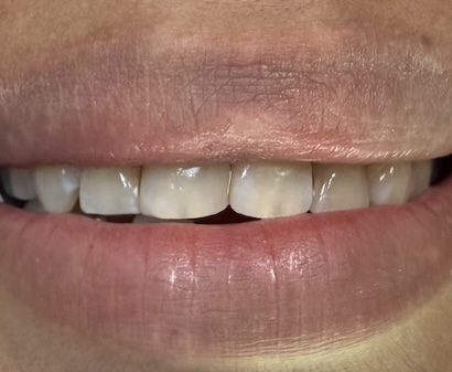 Composite Bonding after