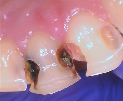 Composite Bonding before