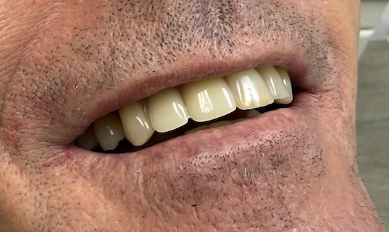 Removable partial denture after