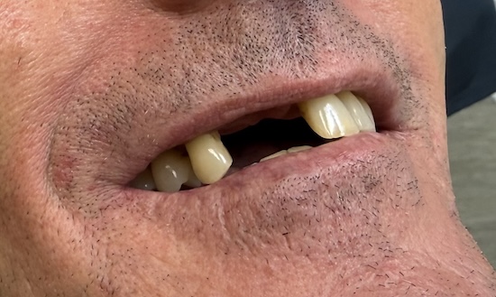 Removable partial denture before