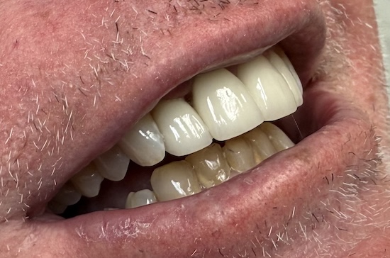 Upper Anterior Crowns after
