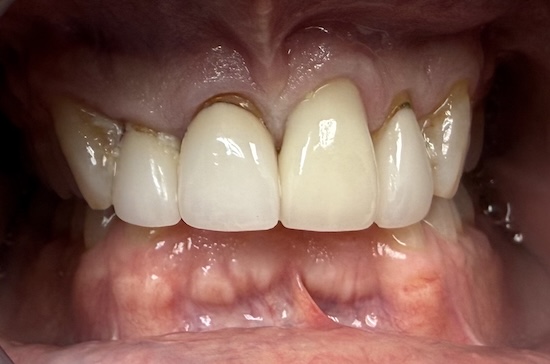 Upper Anterior Crowns before