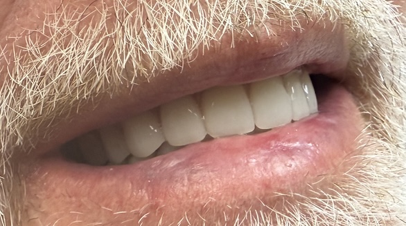 After Maxillary and Mandibular Complete Dentures