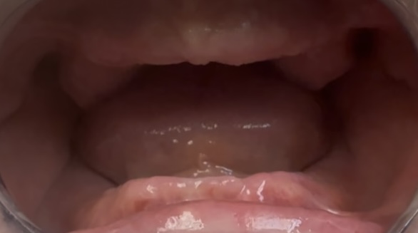 Before Maxillary and Mandibular Complete Dentures