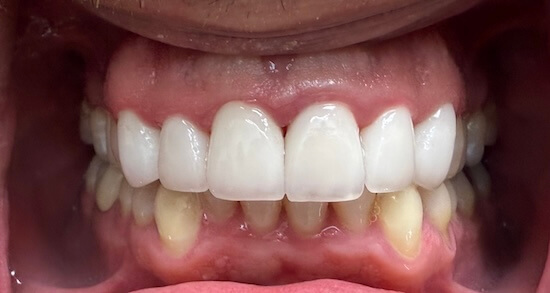 Anterior Upper Crowns After