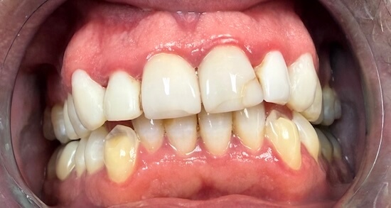 Anterior Upper Crowns Before