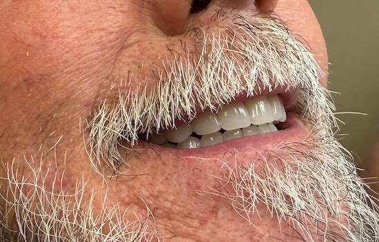 Complete Denture After