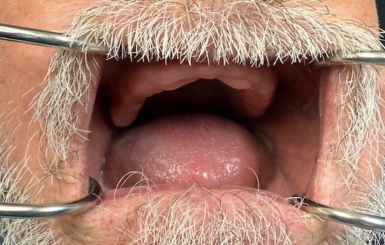 Complete Denture Before