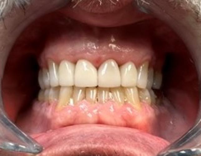 Upper Anterior Crowns after