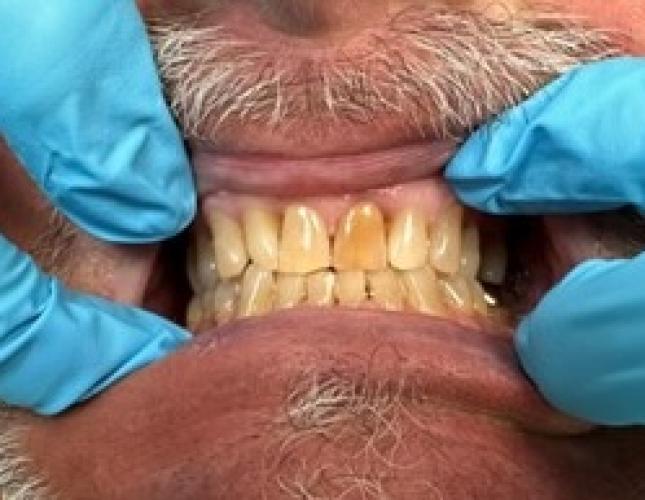 Upper Anterior Crowns before