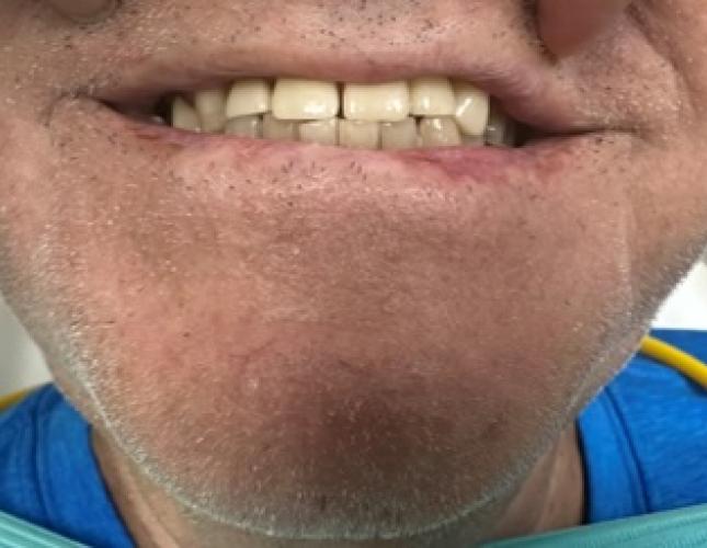 Upper Anterior Crowns after