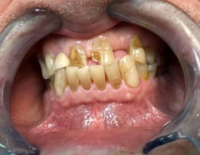 Upper Anterior Crowns before