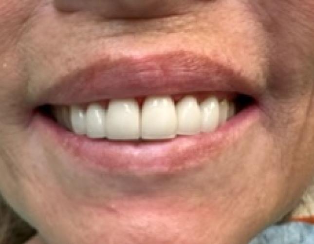 Upper Anterior Crowns after