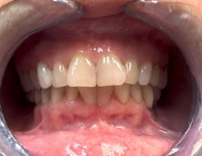 Upper Anterior Crowns before