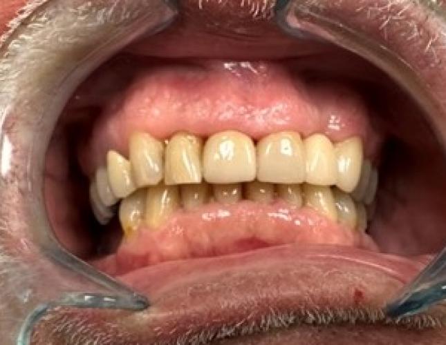 Partial Denture Bridge after
