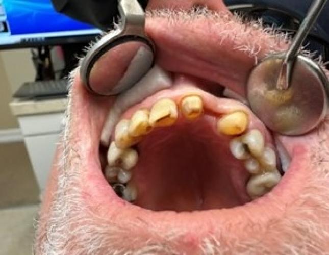 Partial Denture Bridge before
