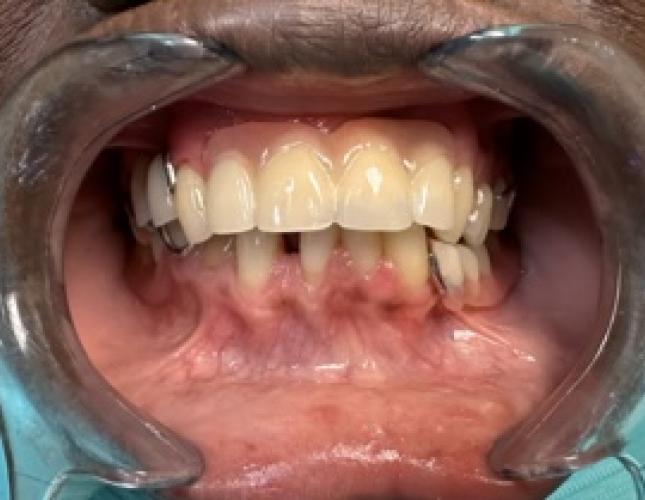 Partial Denture after