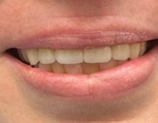Partial denture bridge after