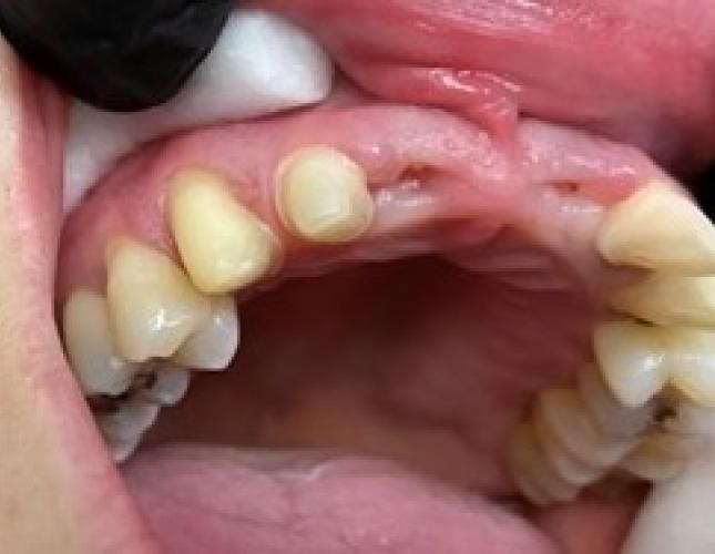 Partial denture bridge
