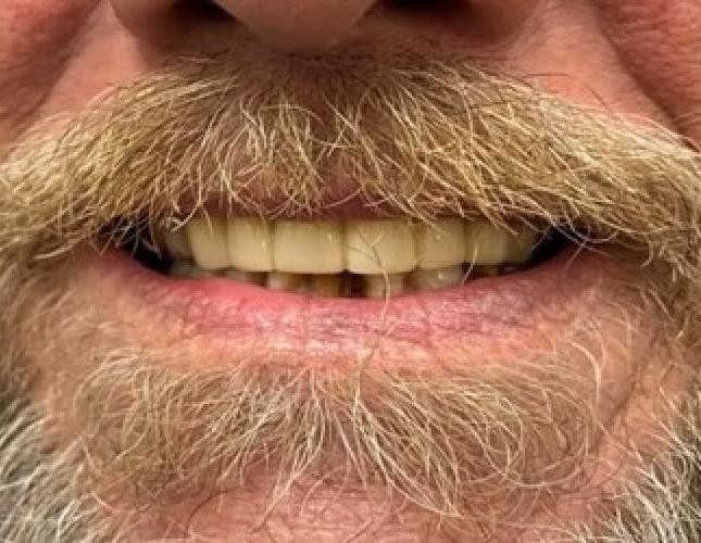 Partial Denture after Partial Denture after