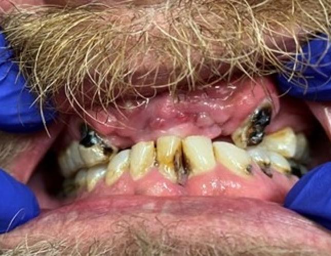 Partial Denture before Partial Denture before