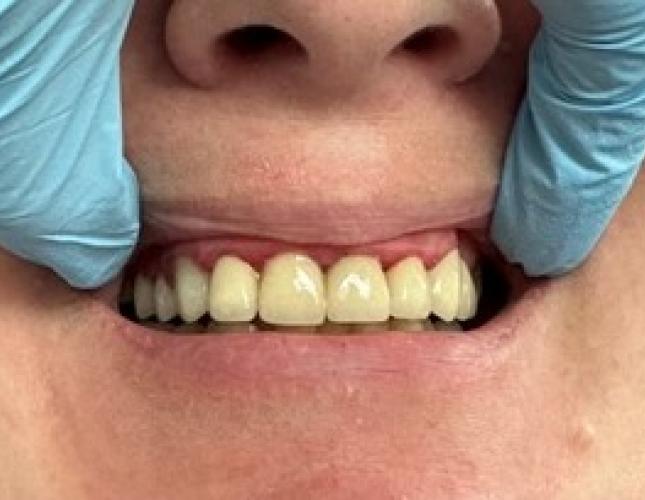 periodontal surgery after