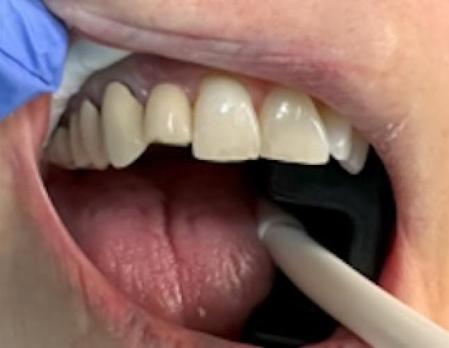 Fixed Partial Denture before