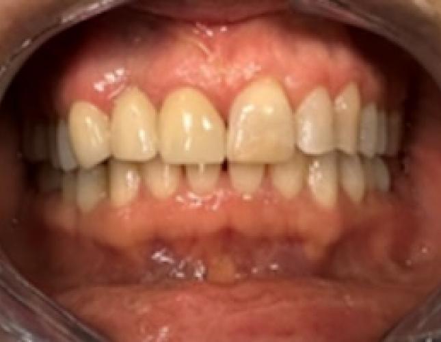Fixed partial denture after
