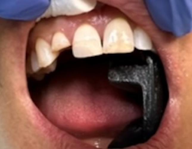 Fixed partial denture before