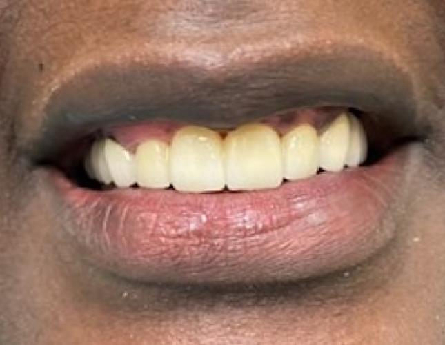 Fixed Partial Denture Bridge after