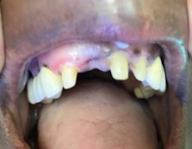 Fixed Partial Denture Bridge before
