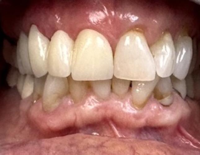 Fixed Partial Dentures Before