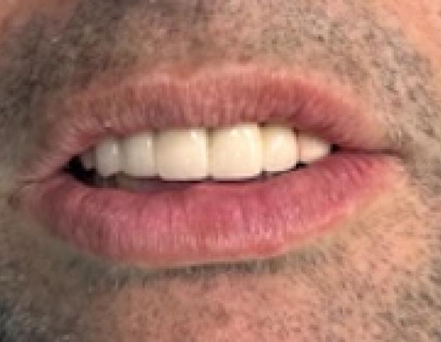 Fixed Partial Denture after