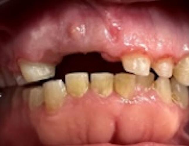 Fixed Partial Denture before