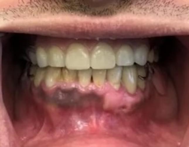 Advanced Prosthetics after