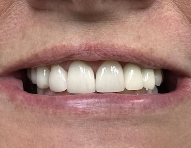 Anterior Crowns and Veneers after