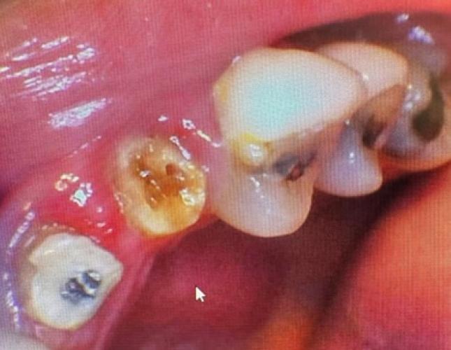 Anterior Crowns and Veneers before