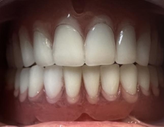 Maxillary and Mandibular Complete Dentures after