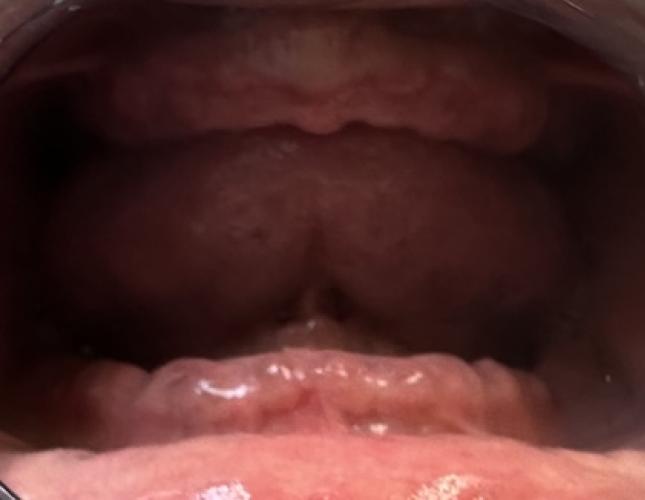 Maxillary and Mandibular Complete Dentures Before