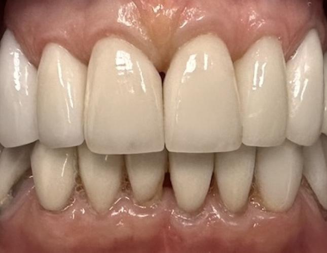 Anterior Upper crowns after