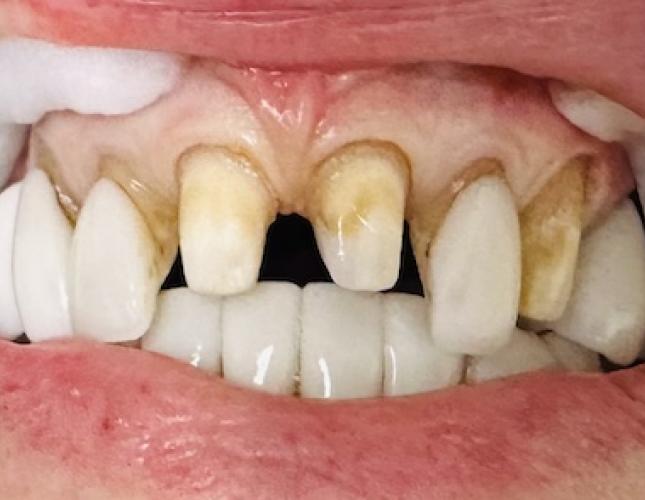 Anterior Upper crowns before