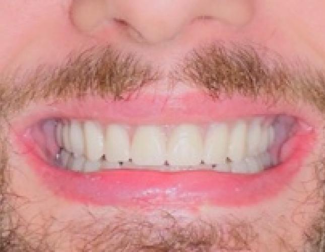 Maxillary And Mandibular Complete Dentures After