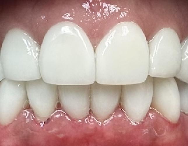 Full mouth reconstruction after
