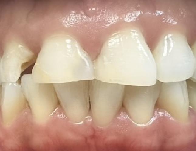 Full mouth reconstruction before