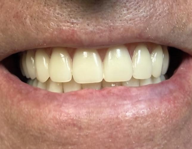 Complete dentures after