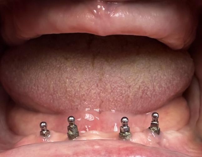 Complete dentures before